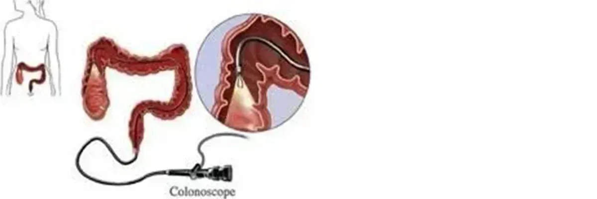 colon and rectal cancer screening